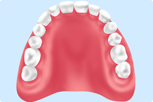 レジン床義歯