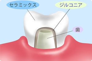 ジルコニアセラミック