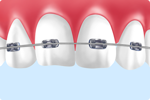 ブラケット矯正