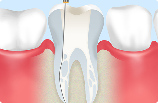 根管治療の重要性